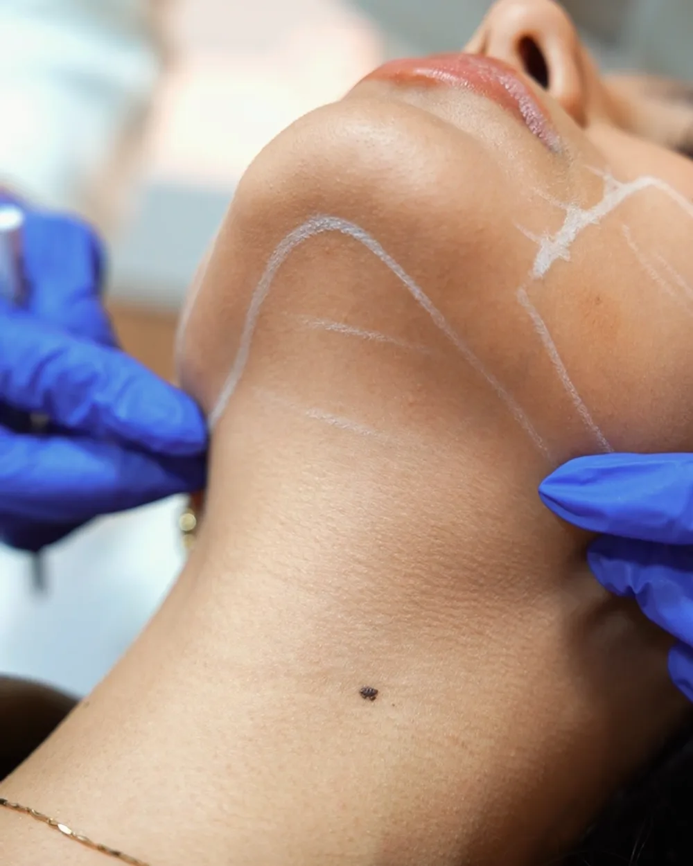 Redefinição do contorno facial